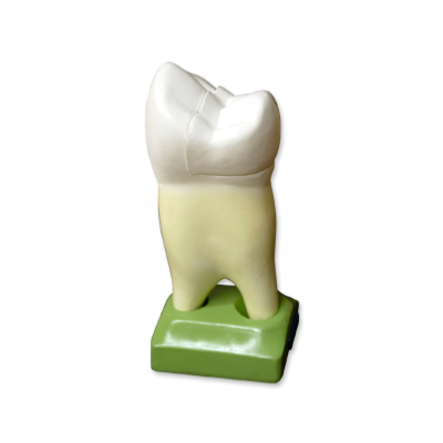 PREMOLAR SUPERIOR 2 CARIES 2 PARTES